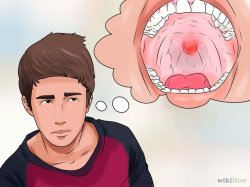 Imagem intitulada Get over Strep Throat Quickly Step 1