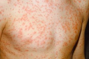 Rubella treatment in adults